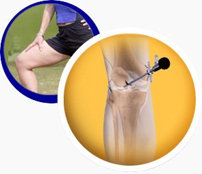 Knee Arthroscopy